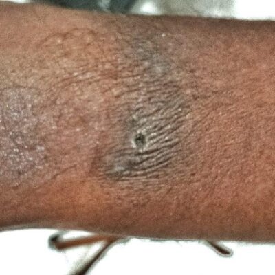 വേങ്ങരയിൽ പെൻഷൻ വിതരണത്തിനിറങ്ങിയ ബാങ്ക് ജീവനക്കാരന് സൂര്യാഘാതമേറ്റു