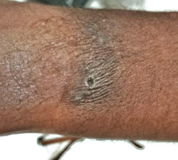 വേങ്ങരയിൽ പെൻഷൻ വിതരണത്തിനിറങ്ങിയ ബാങ്ക് ജീവനക്കാരന് സൂര്യാഘാതമേറ്റു