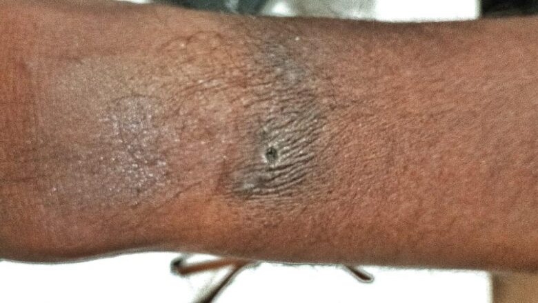 വേങ്ങരയിൽ പെൻഷൻ വിതരണത്തിനിറങ്ങിയ ബാങ്ക് ജീവനക്കാരന് സൂര്യാഘാതമേറ്റു