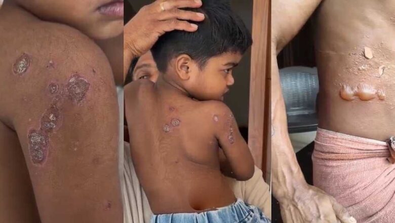 മലപ്പുറത്ത് ചൂട് കടുക്കുന്നു: വളാഞ്ചേരിയിൽ കുട്ടികൾക്കും കൊണ്ടോട്ടിയിൽ യുവാവിനും സൂര്യാതപമേറ്റു