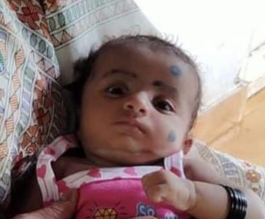 വാൾ ഫാൻ ഉരുകി വീണ് അഞ്ചുമാസം പ്രായമുള്ള കുഞ്ഞ് പൊള്ളലേറ്റു മരിച്ചു